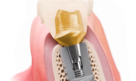 Implantes Ankylos Dentsply Sirona Ecuador