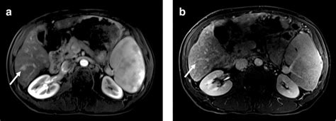 Dynamic Contrast Enhanced Mri Images Show A Focal Lesion In Hepatic