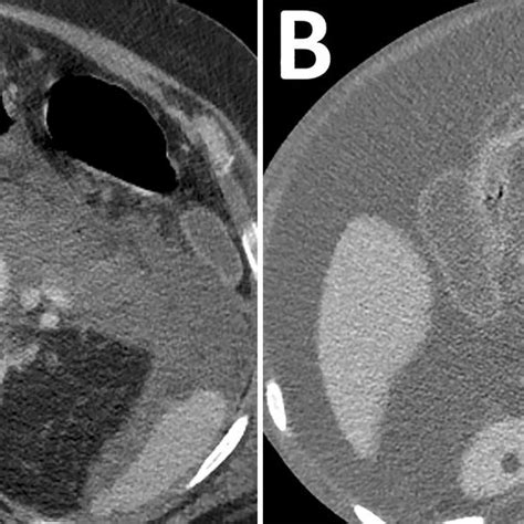 Walled Off Necrosis Won 52 Year Old Male 5 Weeks After Onset Of Download Scientific Diagram