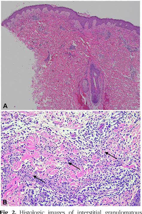 Figure 2 From A Case Of Interstitial Granulomatous Dermatitis