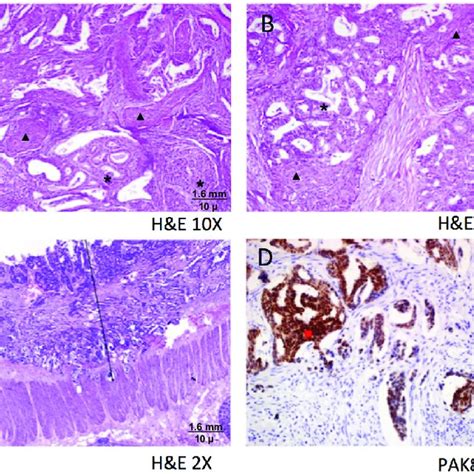 Pdf Synchronous Endometrial And Ovarian Cancer With Sigmoid Colon