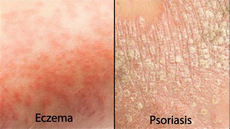 Eczema Vs Psoriasis Apa Yang Sama Apa Yang Berbeza Drridz Skinlabs