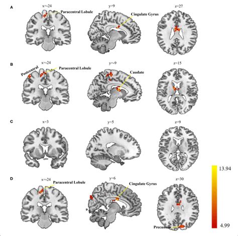 Group Differences In Seed Based Functional Connectivity Fc A Download Scientific Diagram