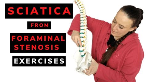 Sciatica From Foraminal Stenosis Exercises Youtube