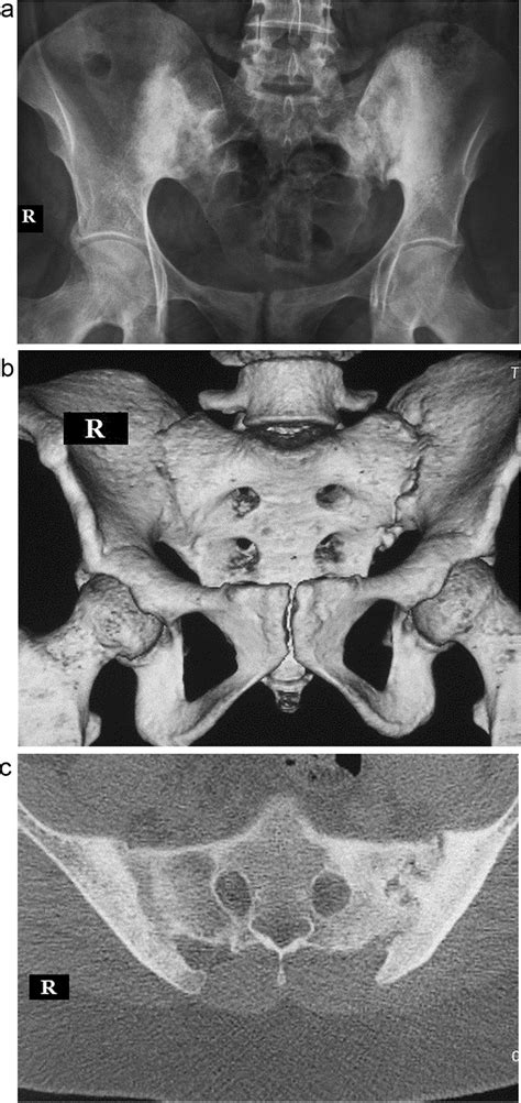 A Plain Radiograph Ap View B Reconstructed Ct Pelvis C Axial Download Scientific