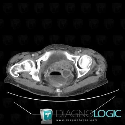 Cas Radiologie M Tastase Scanner Diagnologic