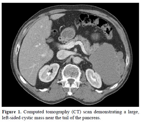 Epidermoid Cyst Occurring Within An Intrapancreatic Accessory Spl