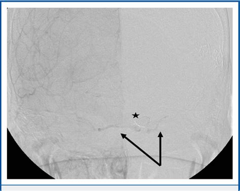 Figure 1 From Transcortical Venous Approach For Direct Embolization Of