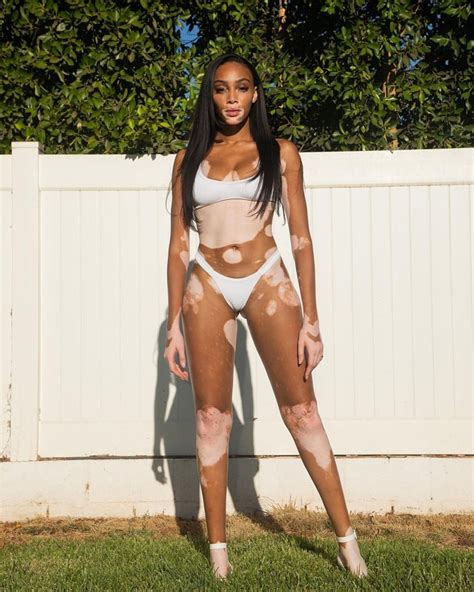 Meet Winnie Harlow, a Supermodel With Vitiligo, Who Has Been Fighting ...