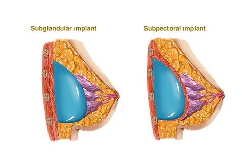 Breast Augmentation Human Rejuvenation