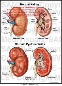 CHRONIC PYELONEPHRITIS Done Flashcards Quizlet