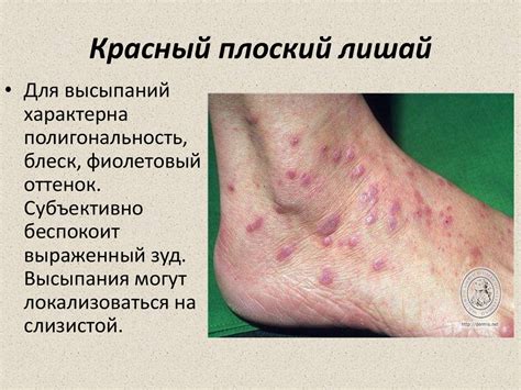 Кольцевидная гранулёма - online presentation