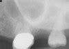 Maxillary Sinusitis Of Endodontic Origin Inside Dentistry