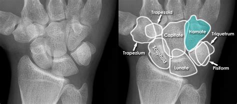 Hamate Dislocation
