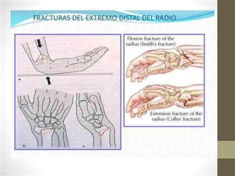 Fracturas De Radio Distal Ppt