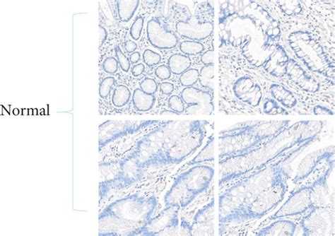 Protein Expression Level Of Bgn In Gastric Cancer Tissue Was Determined