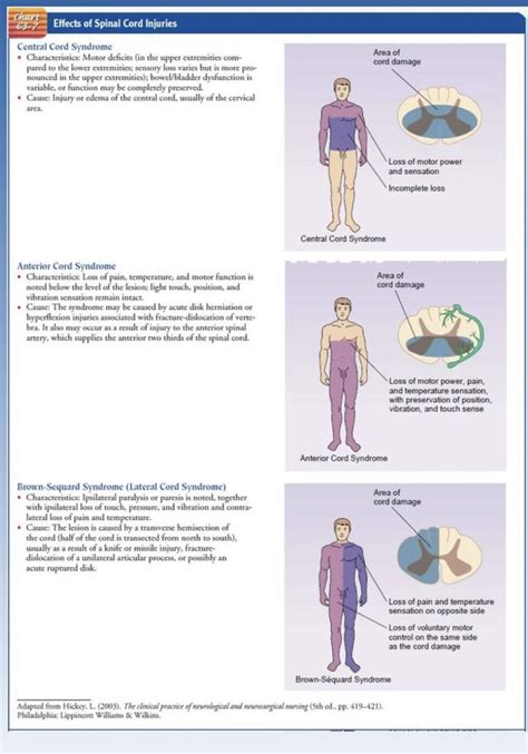 Oren Gottfried Md On Twitter Spinal Cord Syndromes From Hickey