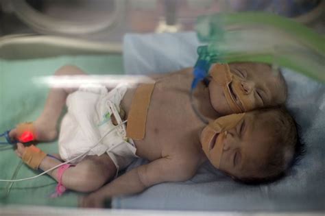 Photos Conjoined Twins Born In Gaza With Two Heads And One Body