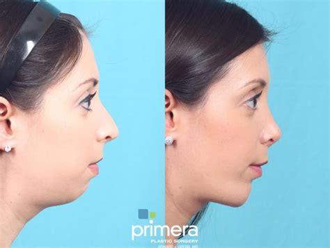 Submentoplasty Chin Tuck Before And After Photo Gallery Orlando Florida Primera Plastic