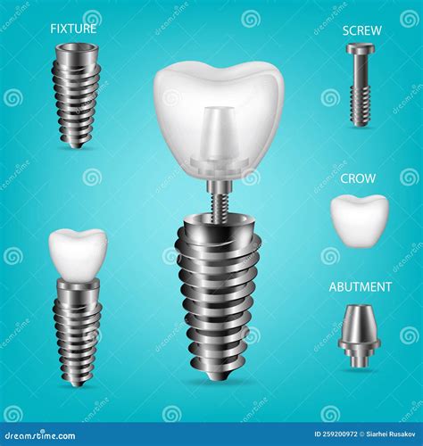 Vector Realistic D Set Of Dental Implants Structural Elements Of A