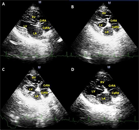 Bidimensional 2d Echocardiogram A B Right Parasternal Long Axis 4