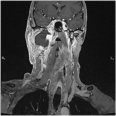 Case 1 Contrast Enhanced T1 Weighted Magnetic Resonance Imaging Shows