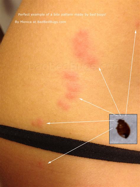 Bed Bug Bites Pictures Symptoms What Do Bed Bug Bites 57 Off