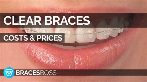 Clear Braces Cost & Prices - Full Pro Guide 2023 - BracesBoss