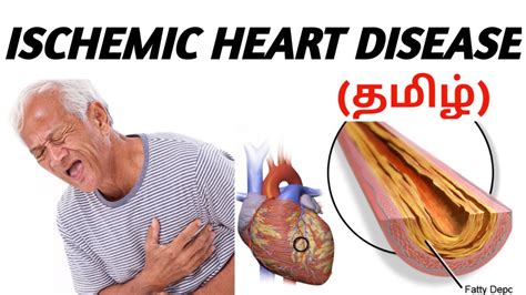 Ischemic Heart Disease Causes Signs And Symptoms Risk Factor