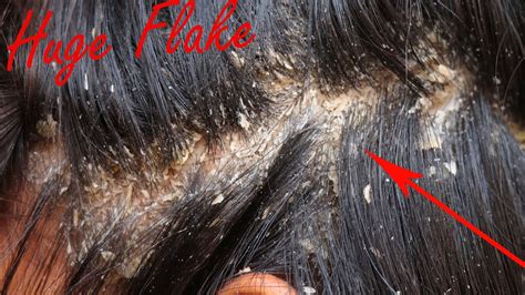 Huge Dandruff Flakes Removal Satisfying Dandruff Scratching