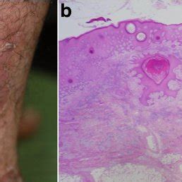 Associated disorders in patients with erosive pustular dermatosis of ...