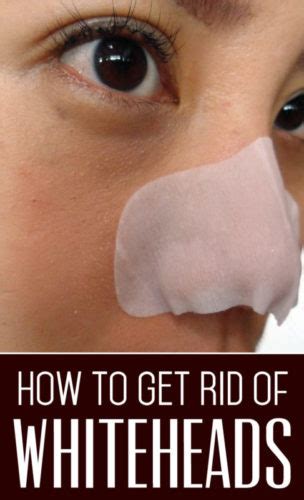 10 Ways to Get Rid of Whiteheads — Info You Should Know