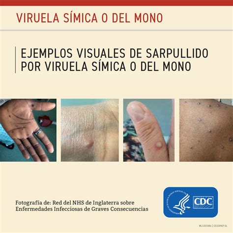 Viruela Del Mono Monkeypox Department Of Health