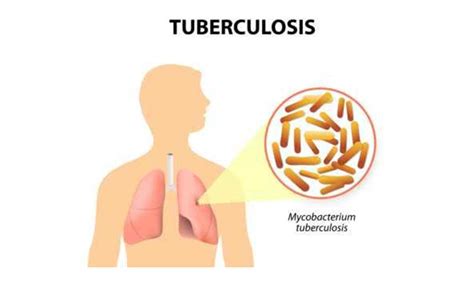 Mengenal Penyakit TBC Gejala Dan Cara Penularannya LENTERAJATENG