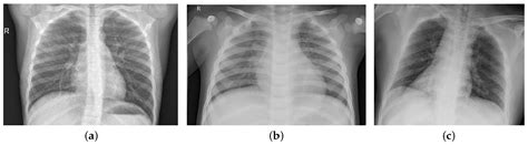 COVID Free Full Text Detecting Coronavirus From Chest X Rays Using