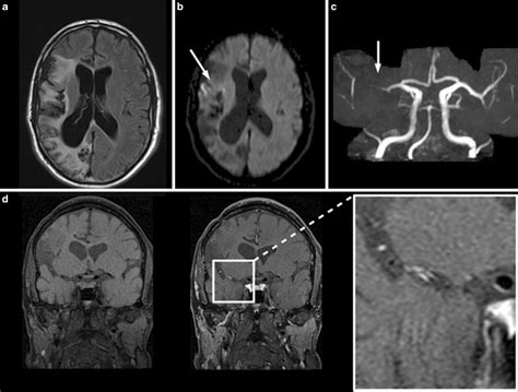 Typical Signs In Medium And Large Vessel Primary Angiitis Of The Download Scientific Diagram