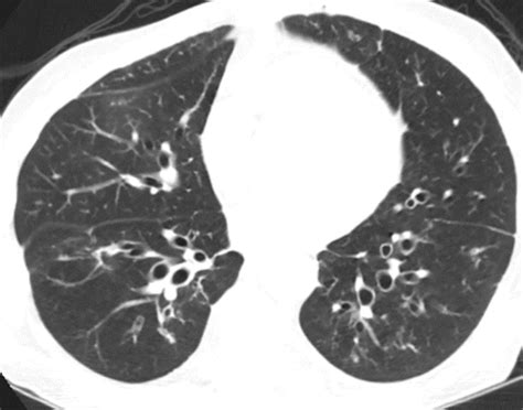 Mai Lung Disease Prognosis - Captions Profile