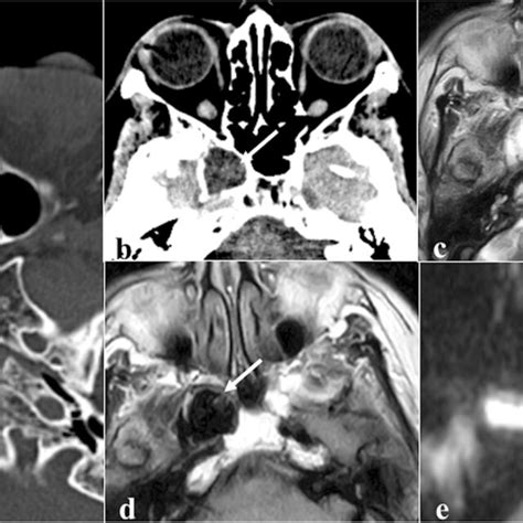 Arrested Pneumatisation Of The Sphenoid Sinus As An Incidental Finding