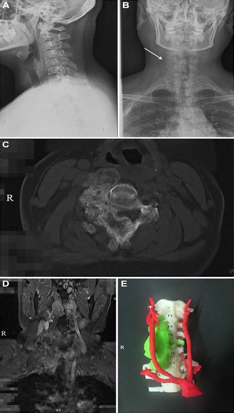 Customized “Whole-Cervical-Vertebral-Body” Reconstruction Af