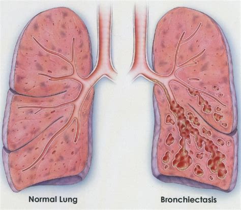 Bronchiectasis Relief Can Be Found In Natural Treatment Herbs
