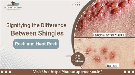 Signifying The Difference Between Shingles Rash And Heat Rash