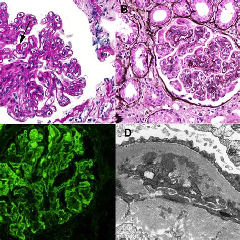 Kidney Biopsy A Glomeruli Showed Endocapillary Proliferation With