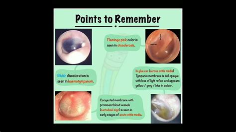 Ciprofloxacin Ear Drops Perforated Tympanic Membrane At Roger Simmons Blog