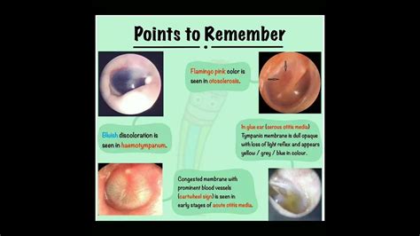 Tympanic Membrane Colour In Different Conditions Doctor Shortsfeed Short Youtube