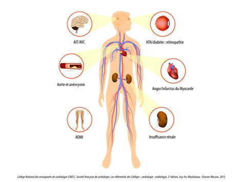 Diabète et Complications cardio vasculaires Diabète 66