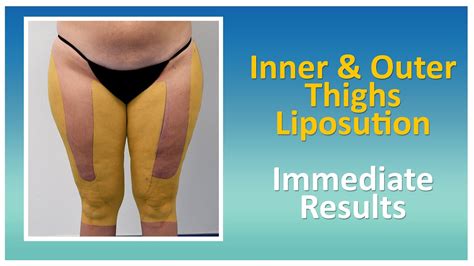 Thigh Knee Liposuction Results Lipo Legs Lipedema Surgery