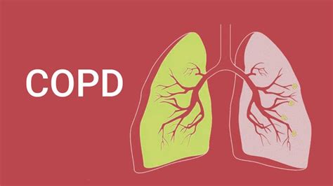 What Are The Four Stages of COPD? – Entirely Health