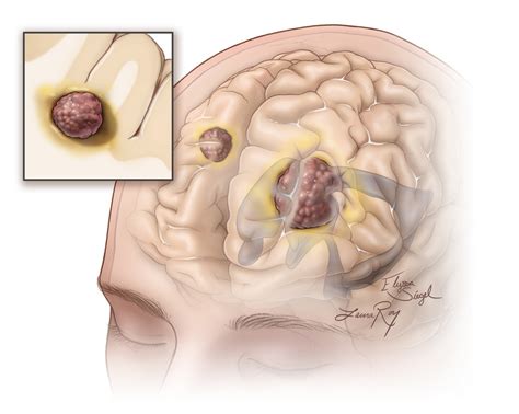 Cancerous Lesions Brain