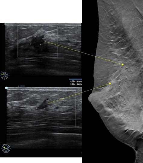 Unifocal Versus Multifocal Breast Cancer Radiology Cases