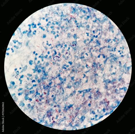 Smear Of Acid Fast Bacilli Afb Stained From Human Body Fluid Specimen